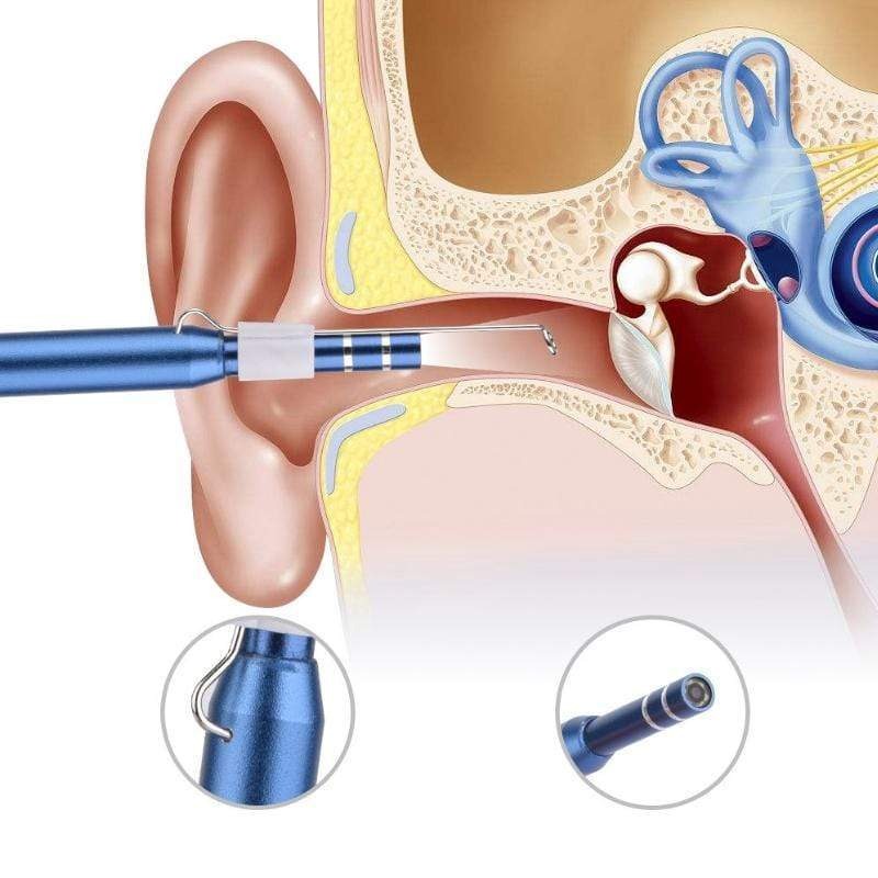 Veriscope™ - Caméra endoscopique pour Nettoyage d'Oreilles
