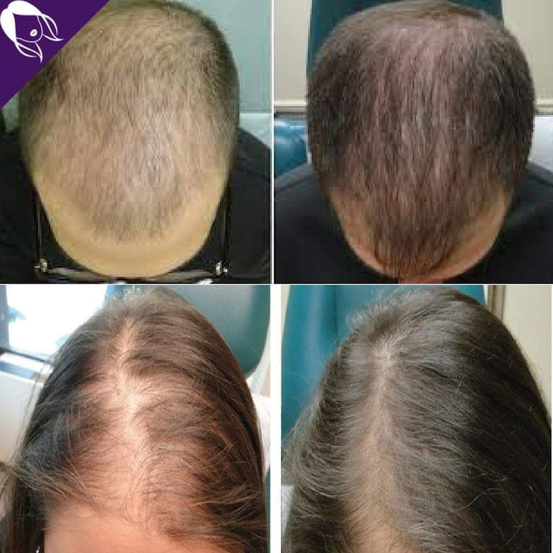 Derma Roller Repousse Cheveux - Micro aiguilles