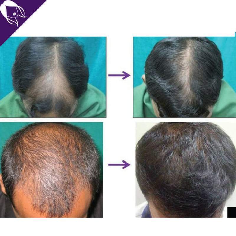 Derma Roller Repousse Cheveux - Micro aiguilles